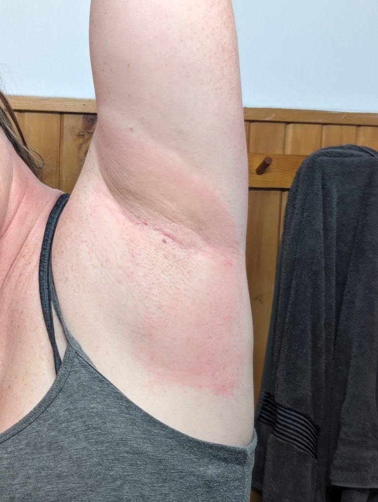 Rash from Deodorant